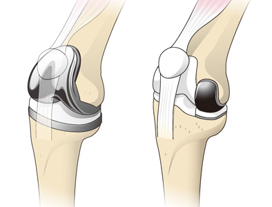人工膝関節全置換術（左）と単顆置換術（右）