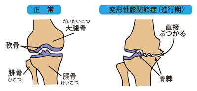 正常な膝と変形性膝関節症（進行期）
