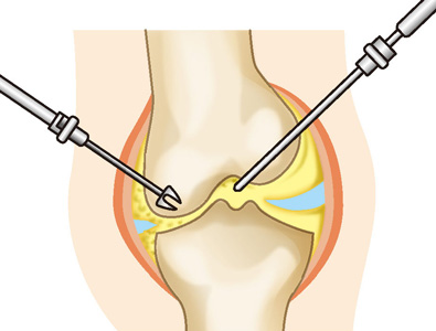 関節鏡視下手術
