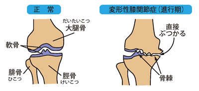 正常な膝と変形性膝関節症（進行期）