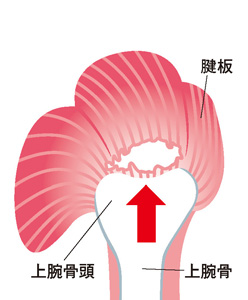 腱板断裂