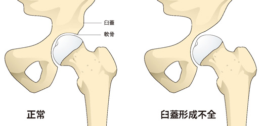 寛骨臼形成不全