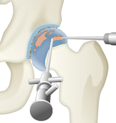 股関節鏡視下手術