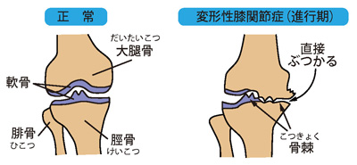 正常な膝と変形性膝関節症（進行期）