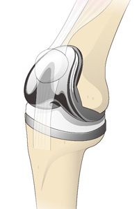 人工膝関節全置換術