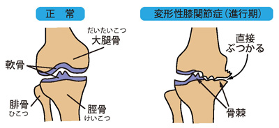 正常な膝と変形性膝関節症（進行期）