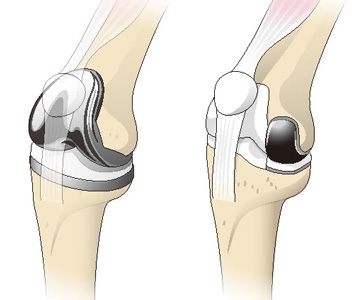 人工膝関節全置換術（左）と部分置換術（右）