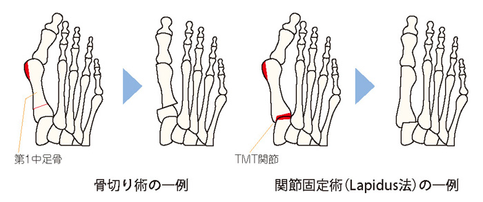 骨切り術の一例と関節固定術（Lapidus法）の一例