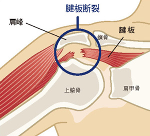 腱板断裂