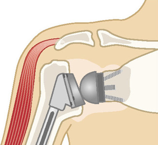 リバース型人工肩関節