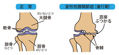 正常な膝と変形性膝関節症（進行期）