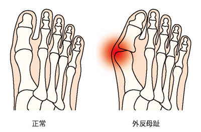 正常な足と外反母趾