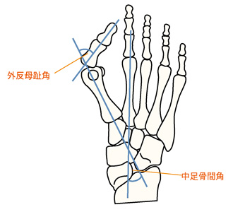 外反母趾角と中足骨間角