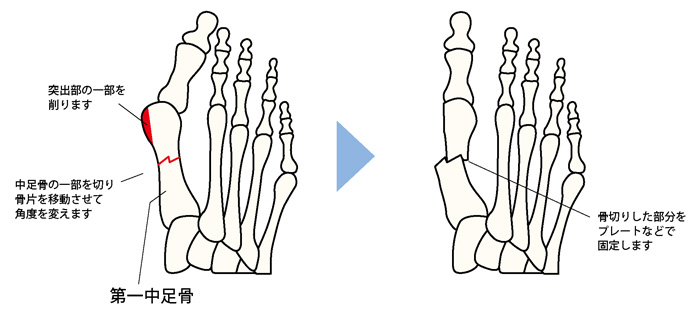 第1中足骨矯正骨切り術の一例