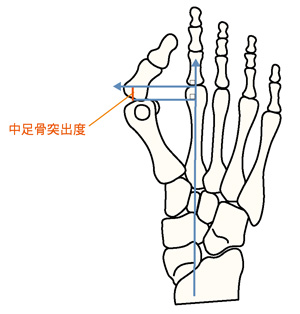 中足骨突出度