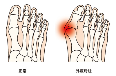 正常な足と外反母趾