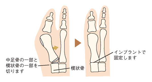 関節固定術のイメージ