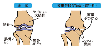 正常な膝と変形性膝関節症（進行期）