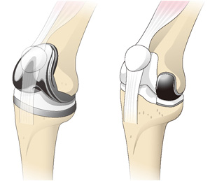人工膝関節全置換術（左）と部分置換術（右）