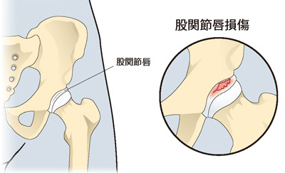 股関節唇損傷