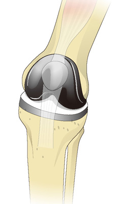 人工膝関節全置換術