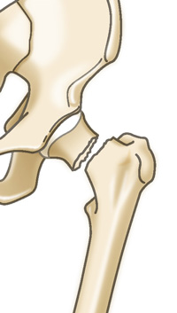 大腿骨頚部骨折