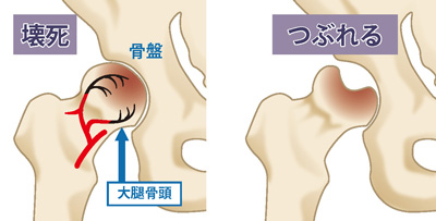 大腿骨頭壊死症