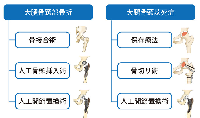 大腿骨頚部骨折と大腿骨頭壊死症