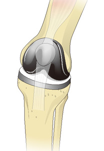 人工膝関節全置換術
