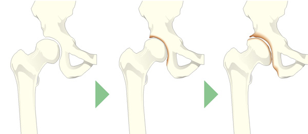 変形性股関節症の進行