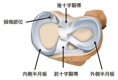内側半月板の後根断裂