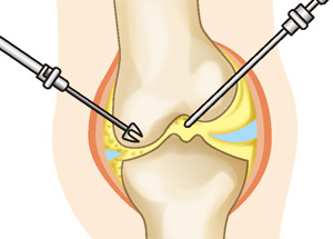 関節鏡視下手術