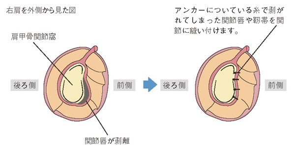 バンカート手術