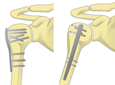 骨接合術の一例