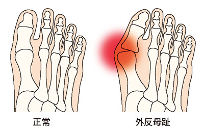 正常な足と外反母趾