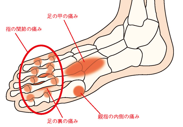 外反母趾の4つの痛み