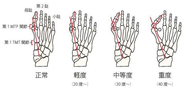 外反母趾の4つの分類