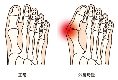 正常な足と外反母趾