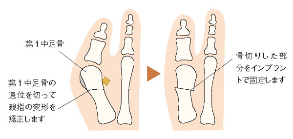 遠位（指先側）骨切り術のイメージ