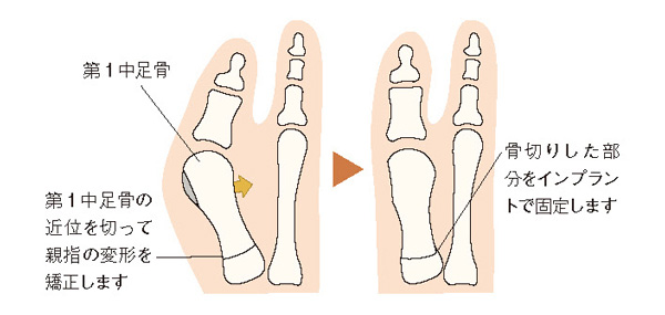 近位（かかと側）骨切り術のイメージ