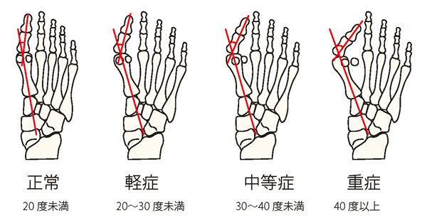 外反母趾