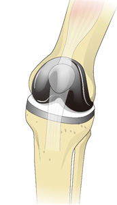 人工膝関節置換術