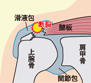 腱板断裂