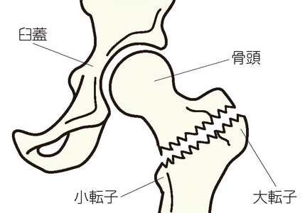 大腿骨転子部骨折