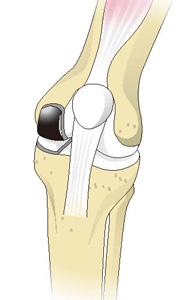 人工膝関節部分置換術