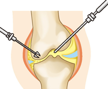 関節鏡手術
