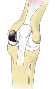 人工膝関節部分置換術