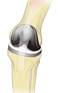 人工膝関節全置換術