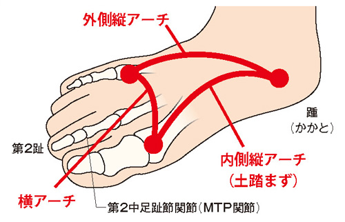 母趾の変形