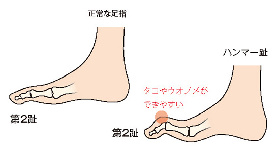 正常な足指とハンマー趾